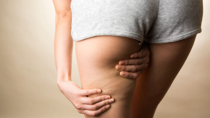 La termografia per combattere la cellulite una rivoluzione nella diagnosi e nel trattamento